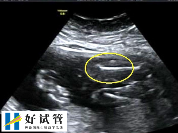 3次B超确认胎儿发育正常即可转产科