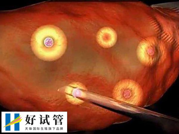 取卵后一个月卵巢是否恢复了(图1)