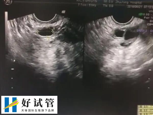 人工授精过程中需严格无菌操作