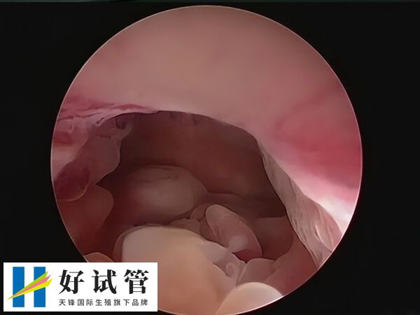 子宫内膜息肉需要检查确诊